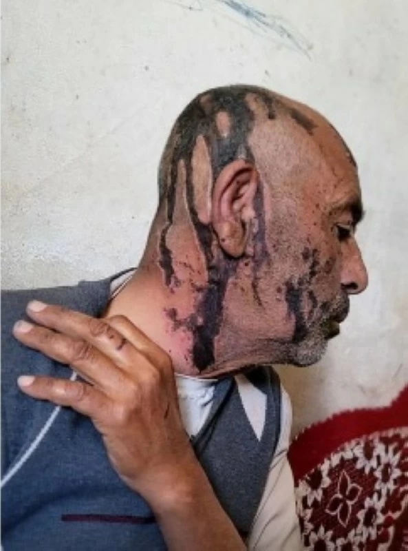 عمران: حوثيان يحرقان والدهما بالأسيد وتفاصيل صادمة